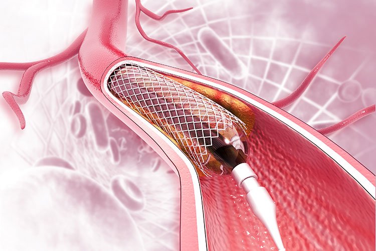 Đặt stent động mạch vành stent